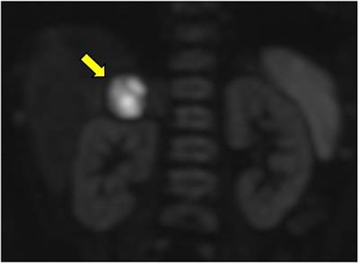 Diffusion-weighted MRI in the identification of renal parenchymal involvement in children with a first episode of febrile urinary tract infection